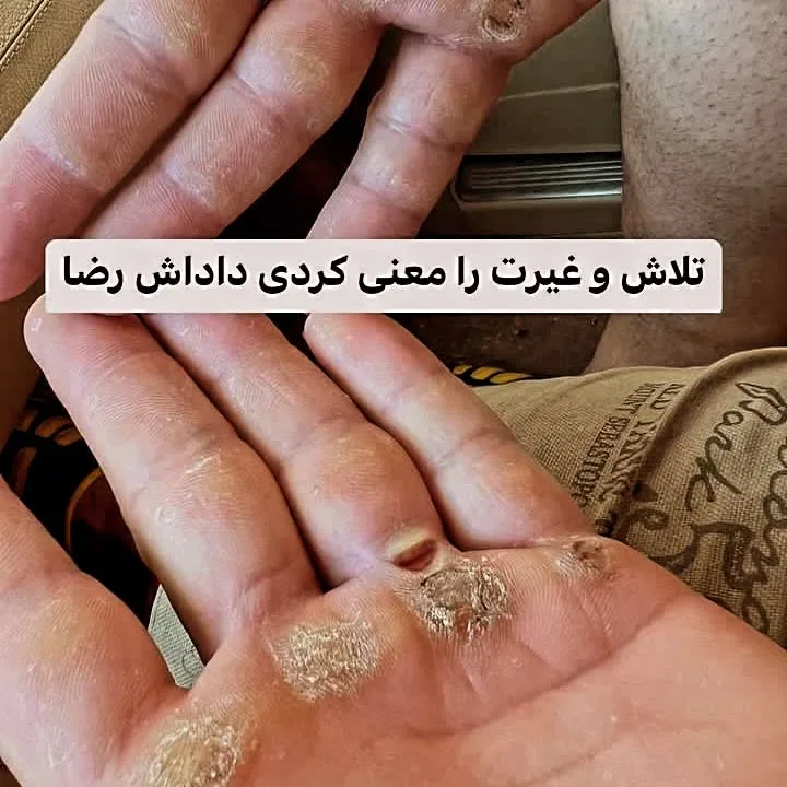 دستان محمدرضا تازه رو پس از مسابقات مردان آهنین