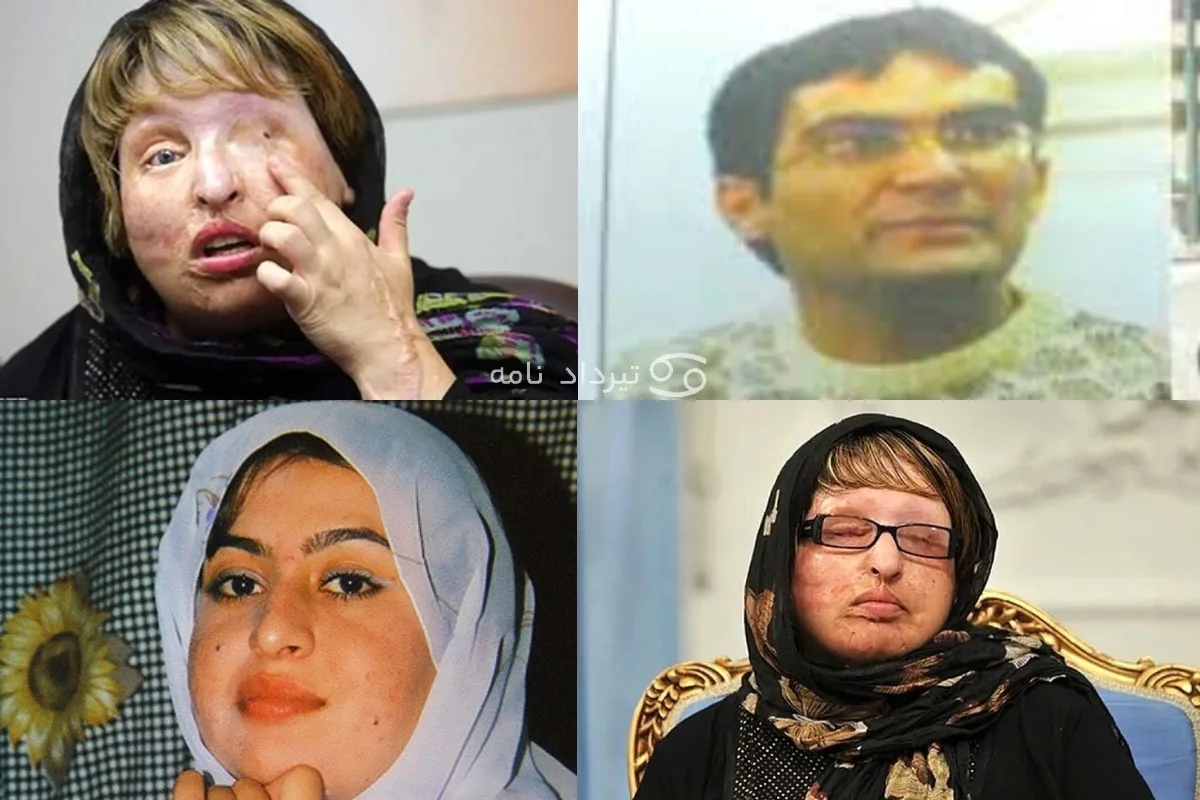 آمنه بهرامی و اسیدپاشی