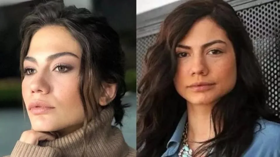 تصاویر دمت اوزدمیر قبل از عمل و تعداد عملهای زیبایی گونه های برجسته، صورت بازتر و شادابتر