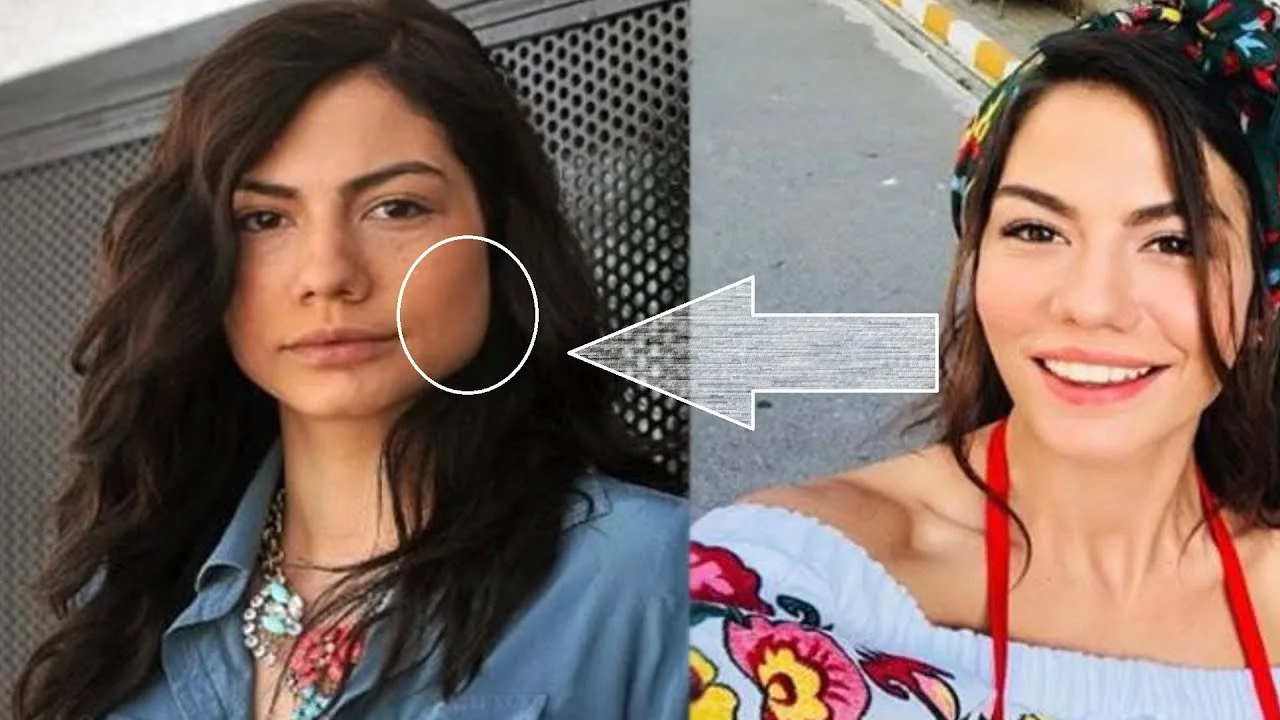 تصاویر دمت اوزدمیر قبل از عمل و تعداد عملهای زیبایی تغییر حالت فک دمت اوزدمیر